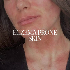 Regimen For Eczema Prone Skin